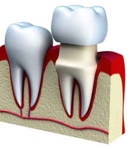 dental crown restoring tooth