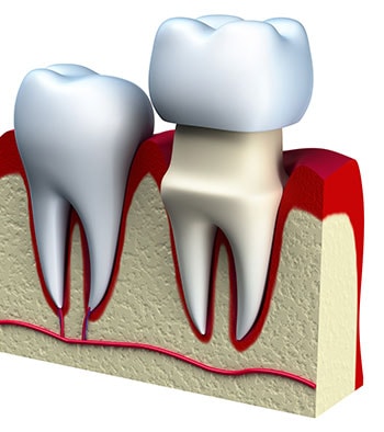 Dental Implants Graphic