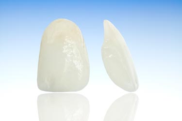 An illustration of a front and side view of porcelain veneers