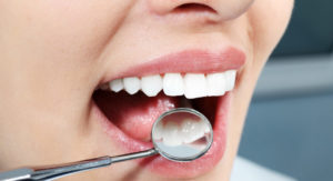 closeup of woman's mouth with dental mirror