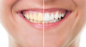 Side by side comparison of a smile with yellowed teeth on the left and white teeth on the right.