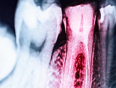 X-ray of two teeth, one highlighted red to show where tooth infection is