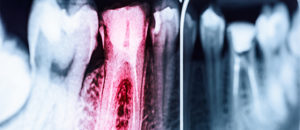 X-ray of root canal