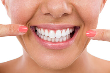 A young woman pointing to her teeth after whitening them with custom-made trays