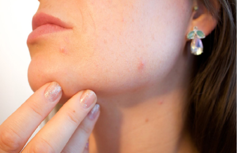 woman checking her face for acne