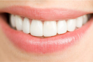closeup of a woman's smile with porcelain veneers
