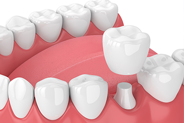 An illustration of dental crowns